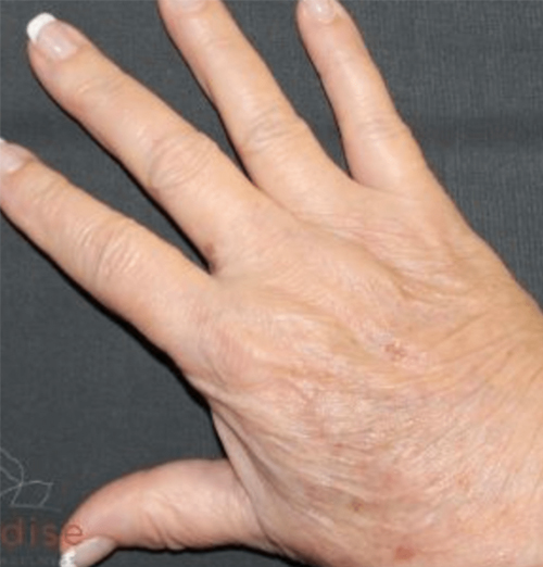 Patient after Hands Fat Grafting