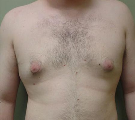 Patient after Male Breast Lipo
