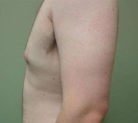 Patient after Male Breast Lipo