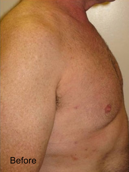 Patient before Male Breast Lipo