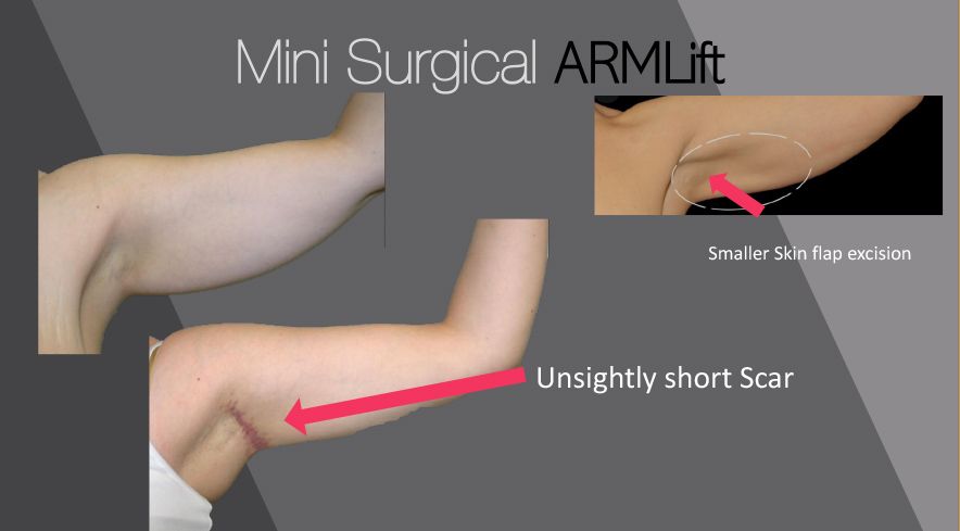 Mini Surgical Arm Lift: smaller skin flap incision, unsightly short scar