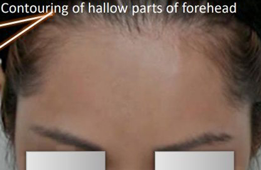 Patient after Non-surgical Forehead Contouring