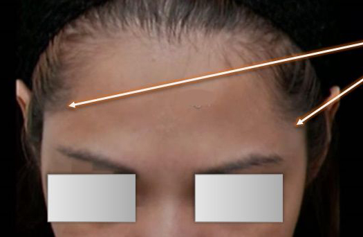 Patient before Non-surgical Forehead Contouring