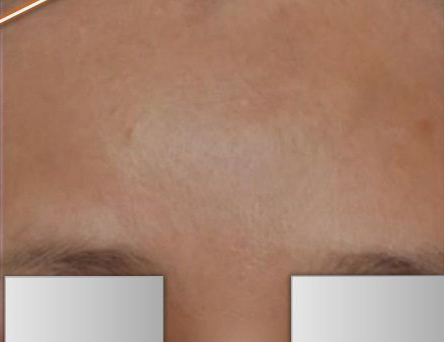 Patient before Non-surgical Forehead Contouring