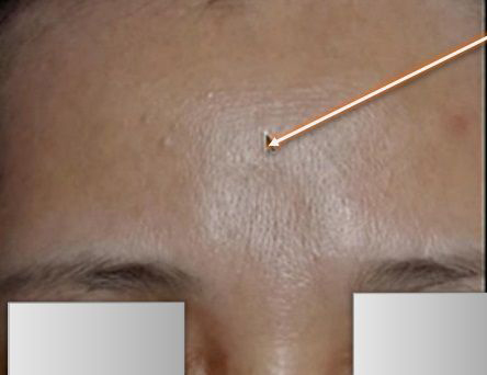 Patient after Non-surgical Forehead Contouring
