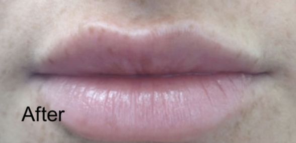 Patient before Nonsurgical Lips Enhancement