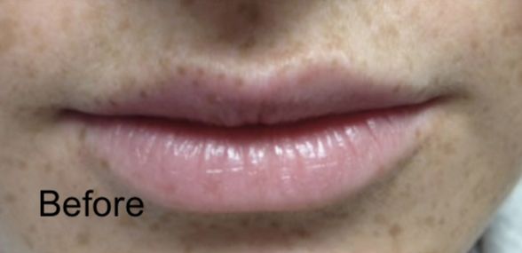 Patient before Nonsurgical Lips Enhancement