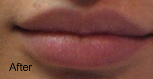 Patient after Nonsurgical Lips Enhancement
