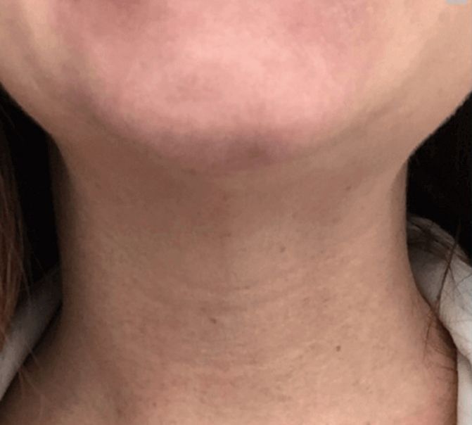 Patient after Nonsurgical Neck Lift