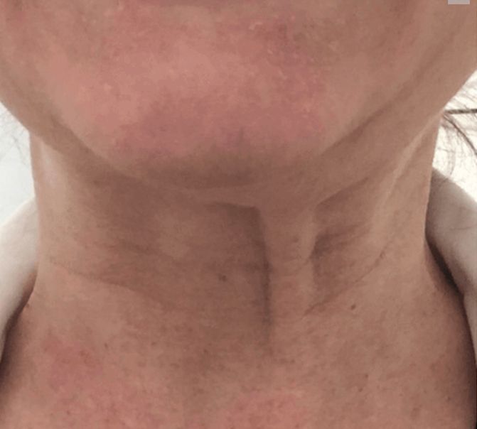 Patient before Nonsurgical Neck Lift