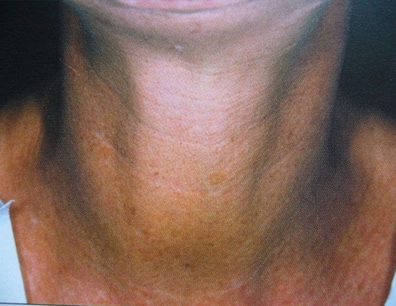 Patient after Nonsurgical Neck Lift
