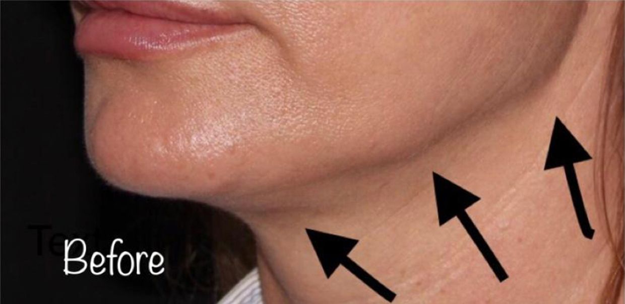Patient before Nonsurgical Neck Lift