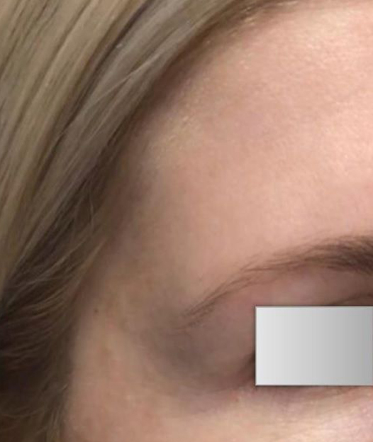Patient before Nonsurgical Temples Contouring