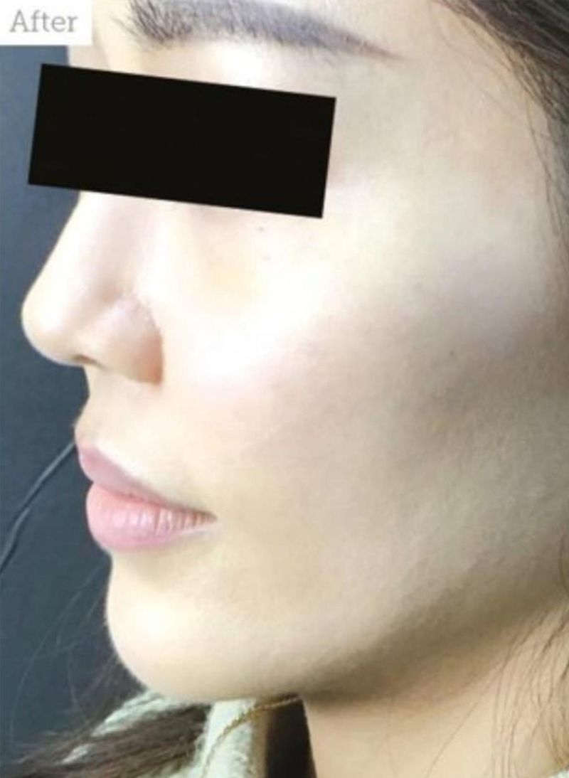 Patient after Nonsurgical Cheeks Lift