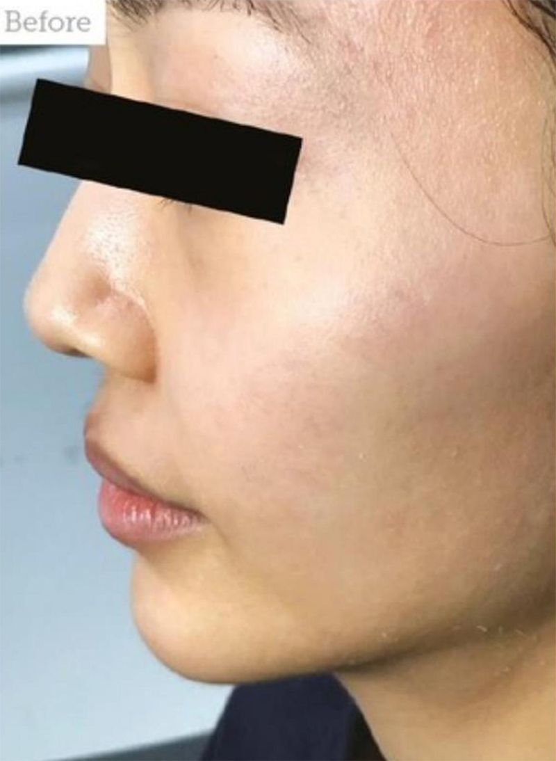 Patient before Nonsurgical Cheeks Lift