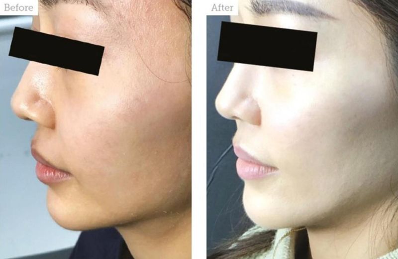 Female patient before and after non-surgical cheeks lift