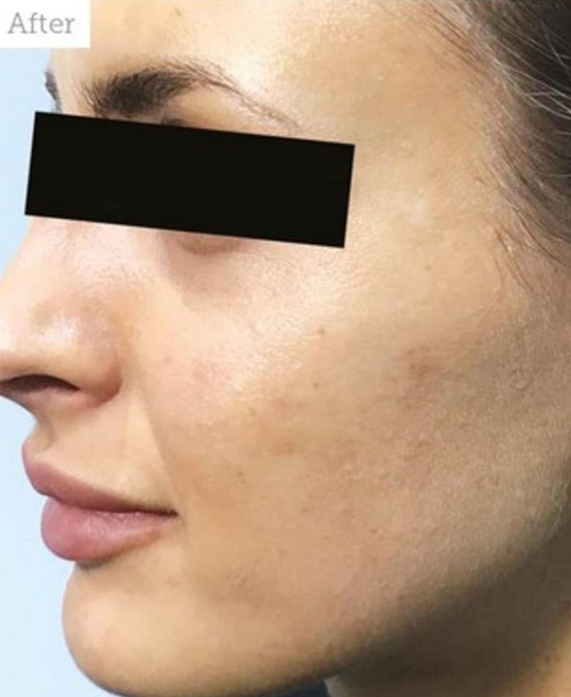 Patient after Nonsurgical Cheeks Lift