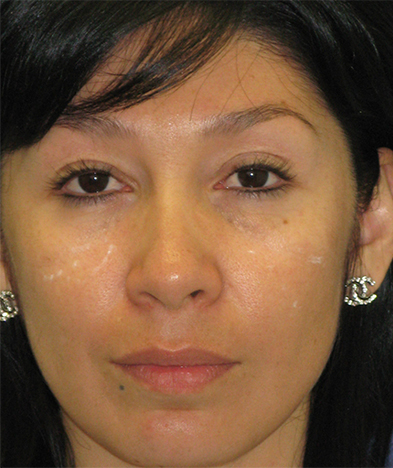 Female patient before Nonsurgical Under Eye Hollow