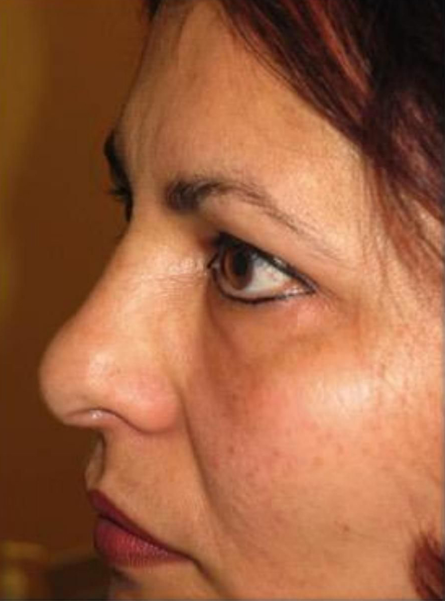 Patient after Nonsurgical Under Eye Hollow