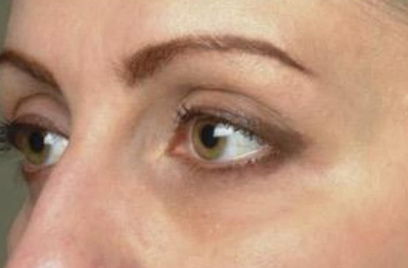 Patient after Nonsurgical Under Eye Hollow