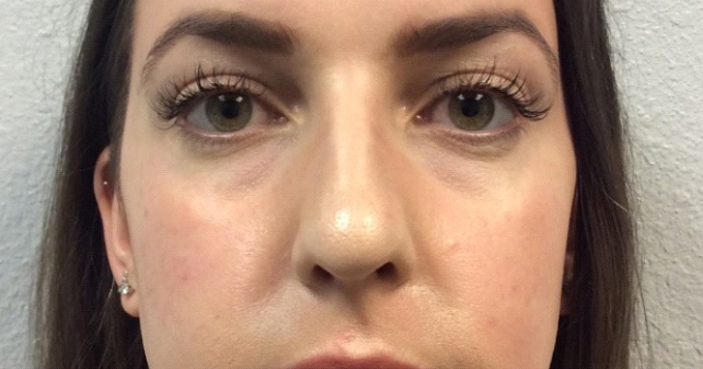 Patient before Nonsurgical Under Eye Hollow