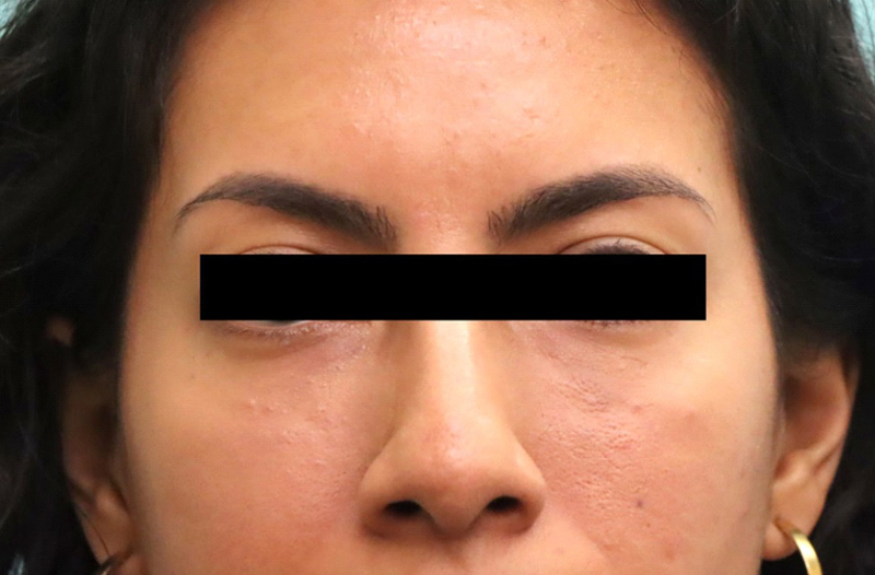 Female patient after Nonsurgical Under Eye Hollow