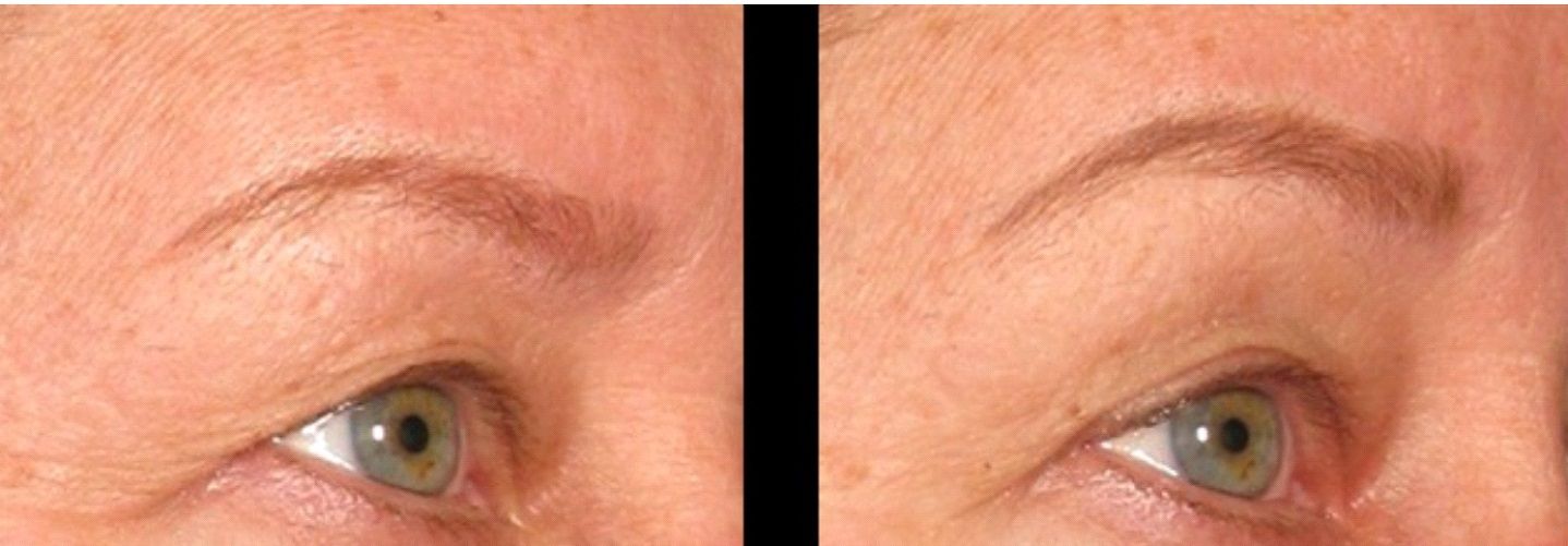 Female patient before and after non-surgical Reaction VST treatment for brow lift
