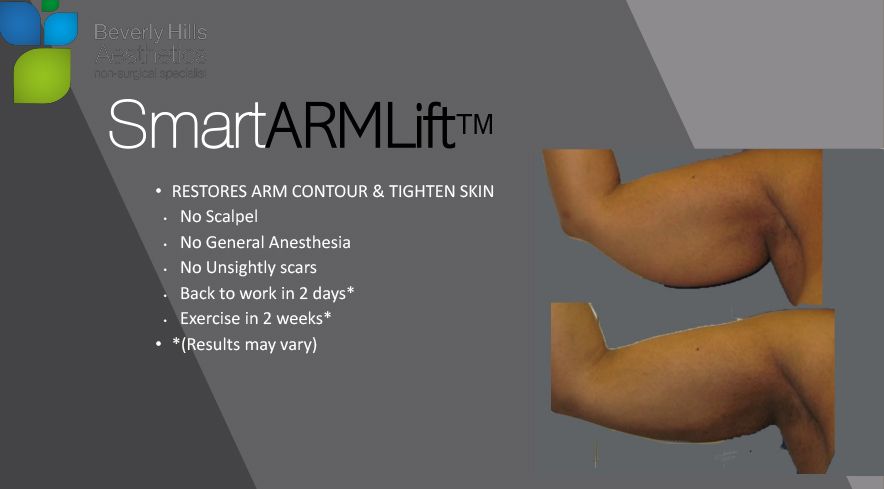 SmartARMLift ™: restores arm contour and tightens skin, No Scalpel, No General Anesthesia, No Unsightly scars, Back to work in 2 days* , Exercise in 2 weeks*, Results may vary
