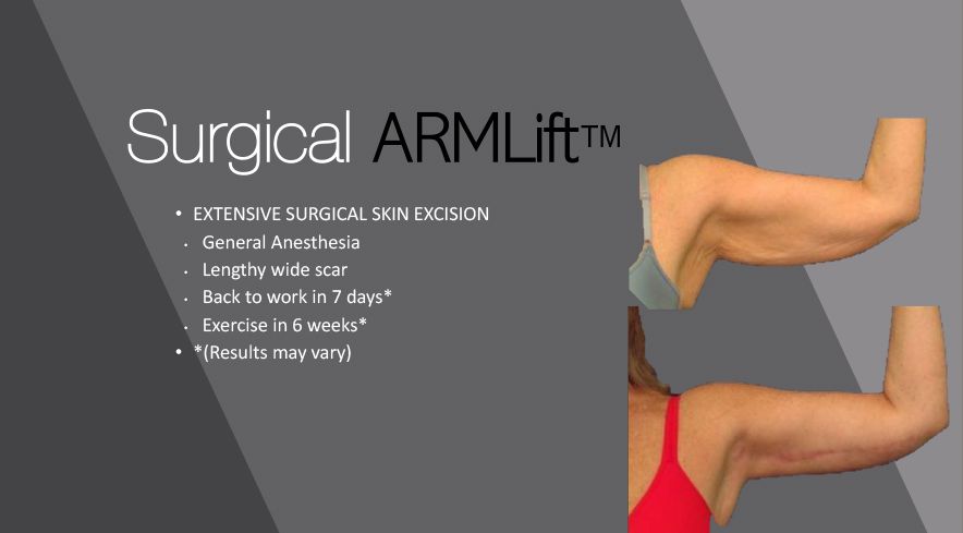 SurgicalARMLift ™: extensive surgical skin condition, General Anesthesia, Lengthy long scar, Back to work in 7 days* , Exercise in 6 weeks*, Results may vary