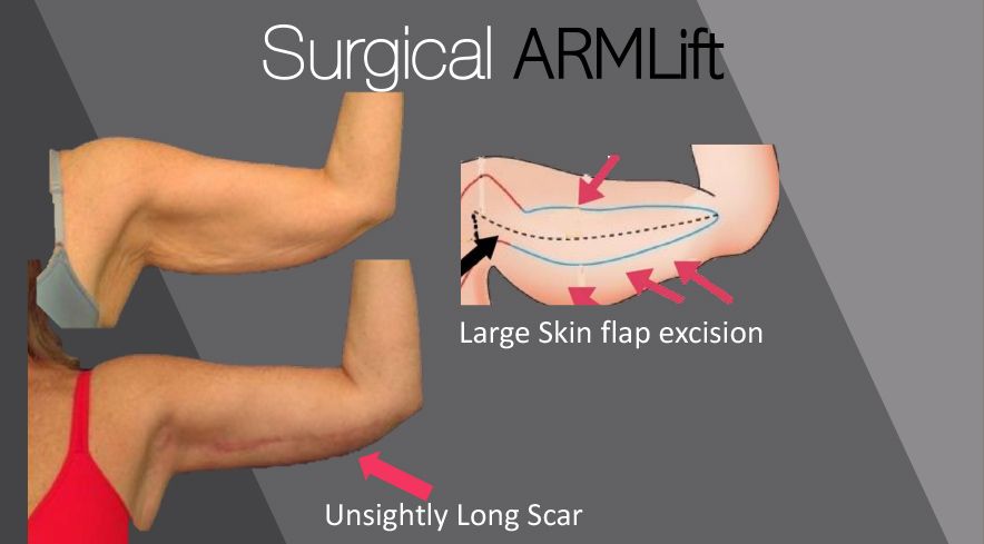 Surgical Arm Lift: Large skin flap incision, unsightly long scar