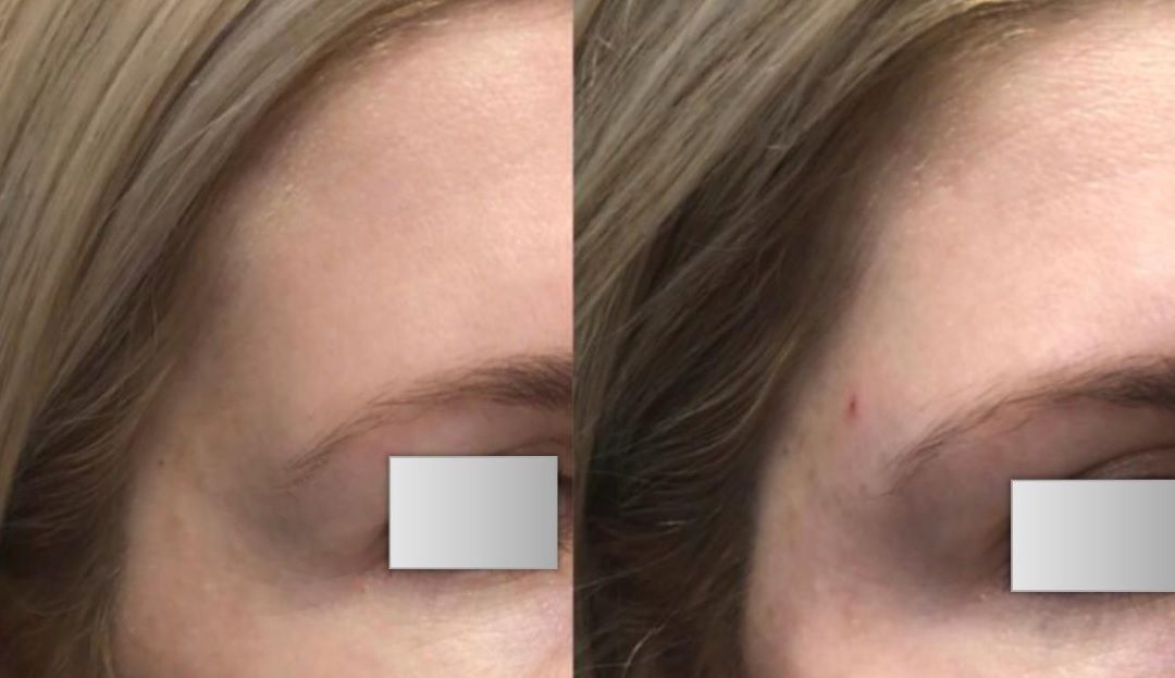 Woman's temple before and after filler temple contouring