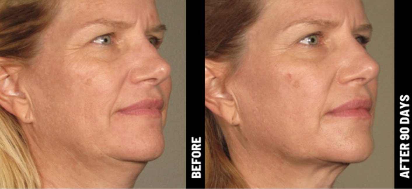 Female patient's face before and after Viora VST Skin Tightening