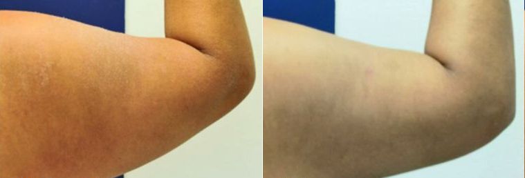 Female patient's arm before and after arms liposuction