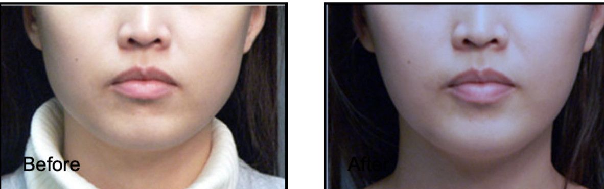 Lower face of a woman before and after face slimming treatment