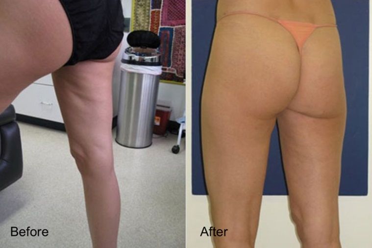 Woman's thighs before and after Botched Lipo Correction
