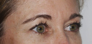Patient before Nonsurgical Browlift