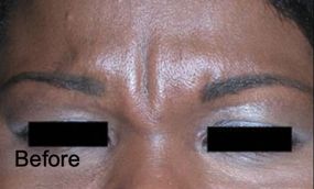 Patient before Nonsurgical Browlift