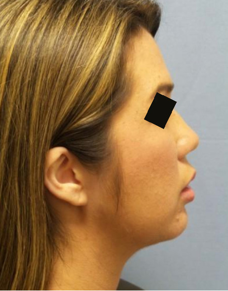 Patient after Nonsurgical Chin Enhancement
