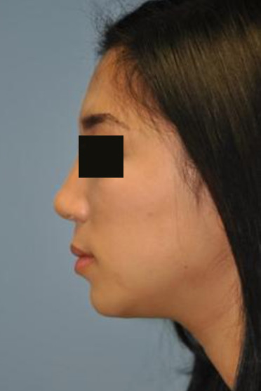 Patient after Nonsurgical Chin Enhancement