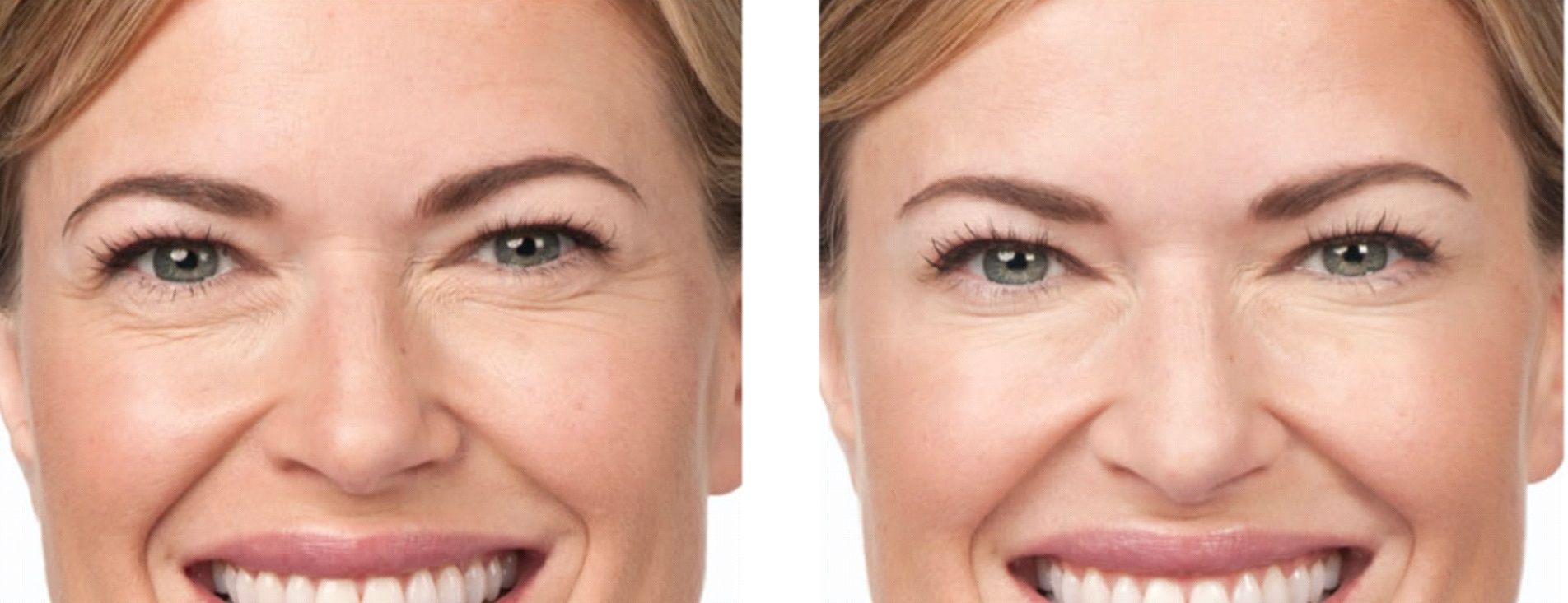 Female patient before and after Botox for crow's feet treatment