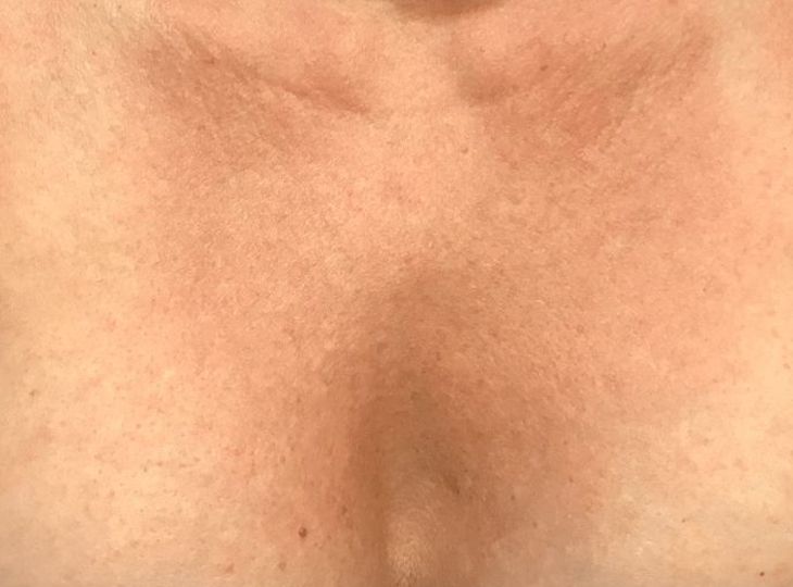 Patient after Decolette - Cleavage Chest Wrinkles