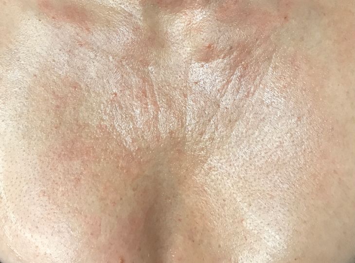 Patient before Decolette - Cleavage Chest Wrinkles