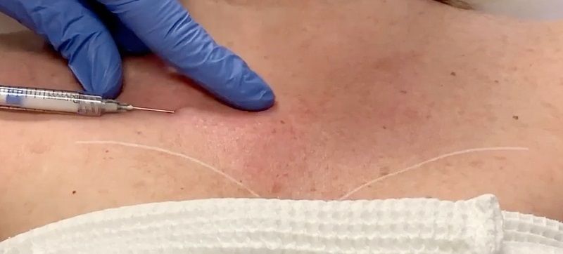 Chest rejuvenation with dermal filler