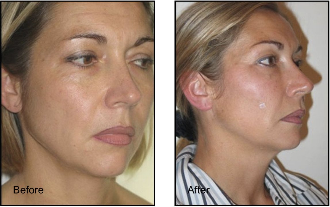 female patient before and after non-surgical facelift with facial fat grafting