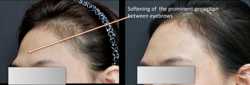 Woman's forehead before and after softening of the prominent projection between eyebrows