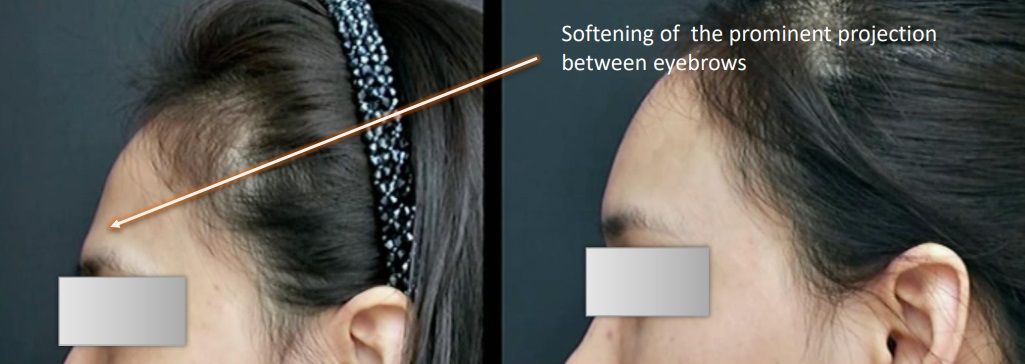Woman's forehead before and after softening of the prominent projection between eyebrows