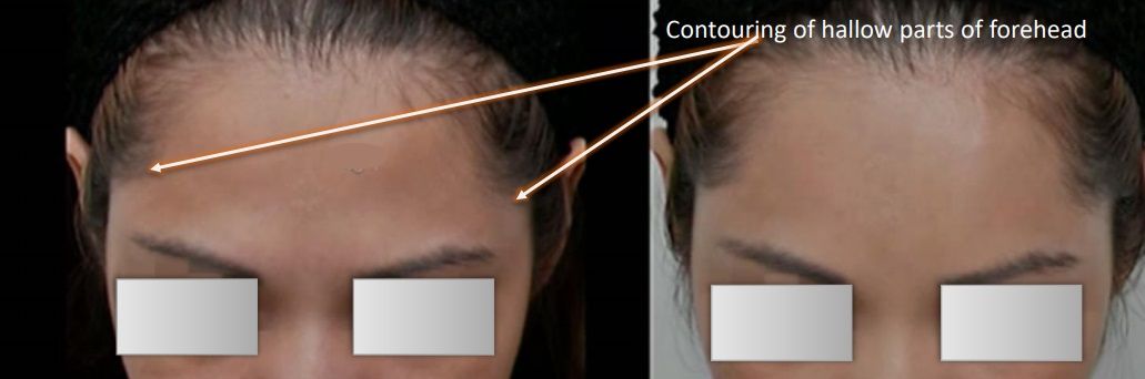 Woman's forehead before and after softening of the contouring of hallow parts of forehead