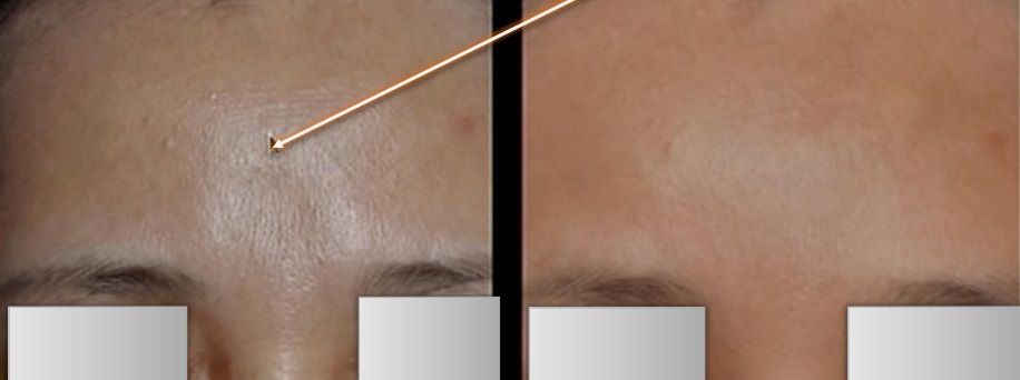Woman's forehead before and after forehead contouring treatment