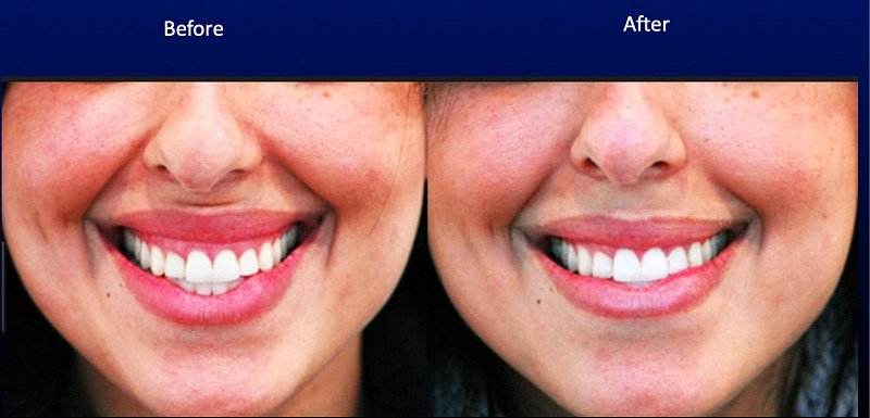 Female patient before and after Botox® gummy smile treatment

