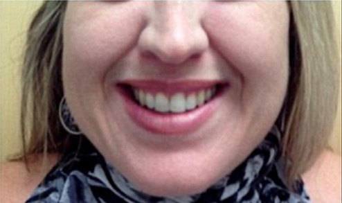 Patient after Neurotox For Gummy Smile procedure